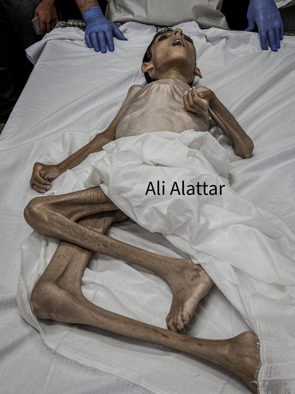 تصویر بسیار تکاندهنده از شهادت کودک فلسطینی بر اثر سوء تغذیه