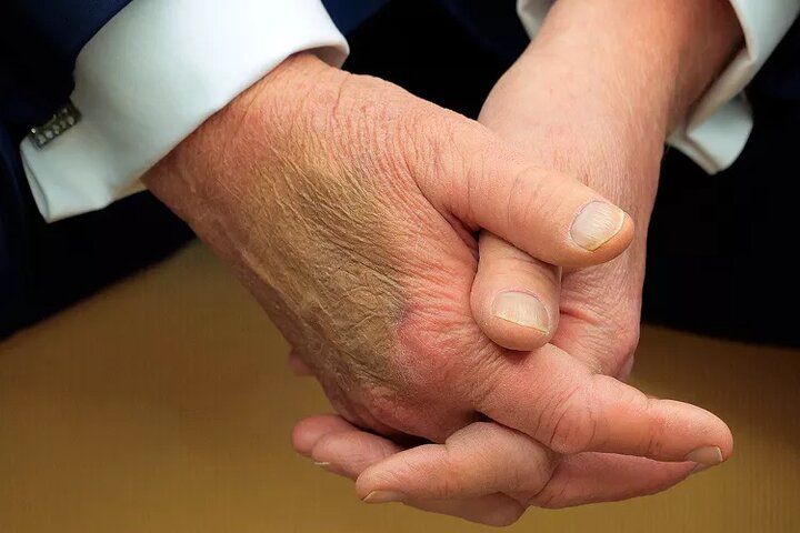 Right -handed bruise “Trump” became the subject of photographers