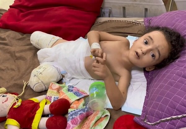 Gaza Sees Alarming Rise in Congenital and War-Related Disabilities Amid Ongoing Conflict /Gaza , congenital disabilities , war impact , malnutrition , infant mortality