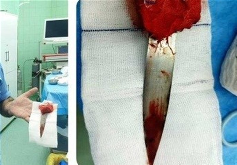 خروج چاقوی ۲۴ سانتیمتری از سر بیمار در مشهد + عکس