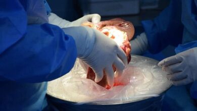 انجام موفقیتآمیز پیوند کبد با اهدای عضو 2 بیمار مرگ مغزی در بیمارستان امام رضا(ع) تبریز