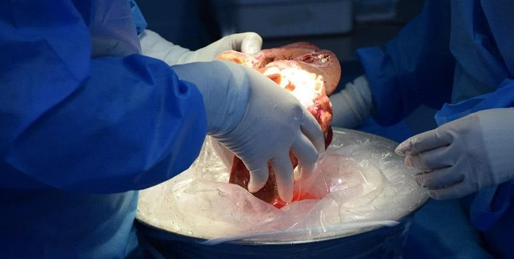 انجام موفقیتآمیز پیوند کبد با اهدای عضو 2 بیمار مرگ مغزی در بیمارستان امام رضا(ع) تبریز