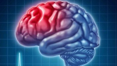 علائم سکته مغزی را بشناسیم