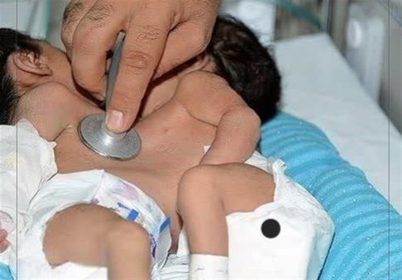 آغاز عمل جداسازی دوقلوی بههم چسبیده در شیراز/ آیا دو قلوها زندگی تازهای را تجربه میکنند؟ + فیلم