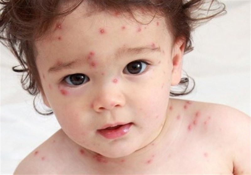احتمال انتقال آبله مرغان از بیمارِ بدون علائم