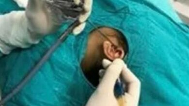 اولین عمل جراحی اندوسکوپیک ترمیم پارگی پرده گوش در طبس