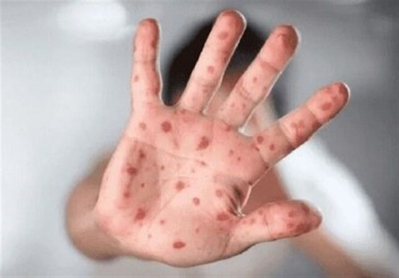موردی از بیماری آبله میمون در کشور مشاهده نشده است