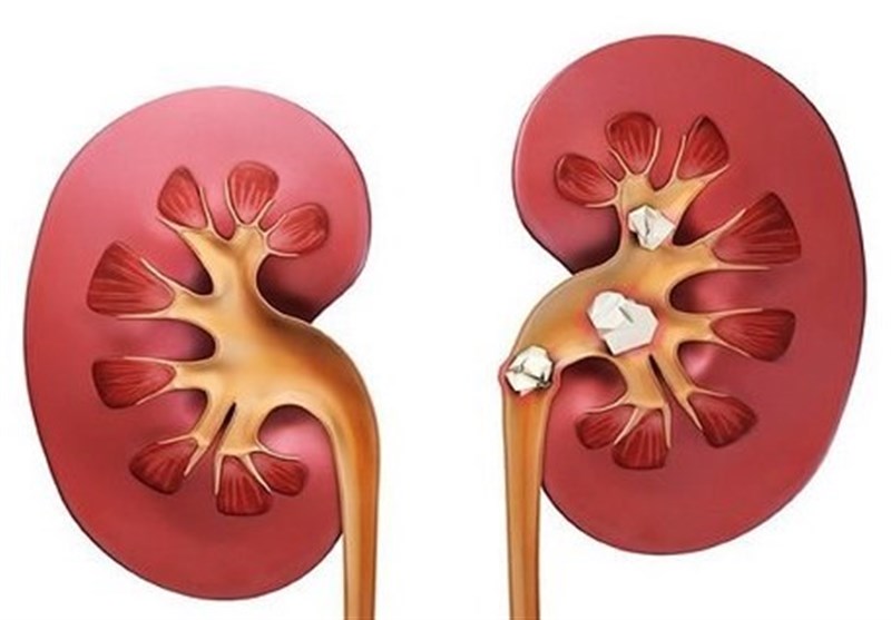 عواقب مصرف خودسرانه مکملها و داروهای بدنسازی/ نابودی کلیه!