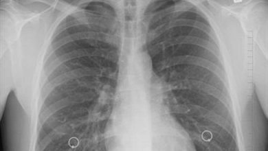 افزایش نگرانکننده سرطان ریه در گلستان/ تریاک خطر ابتلا را 3.6 برابر افزایش میدهد / اخبار گلستان - اخبار استانها