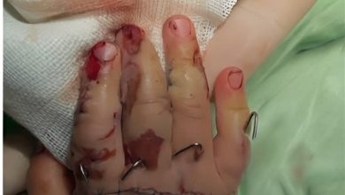 پیوند انگشتان دختربچه یکساله با جراحی 7 ساعته در خرمآباد / اخبار لرستان - اخبار استانها