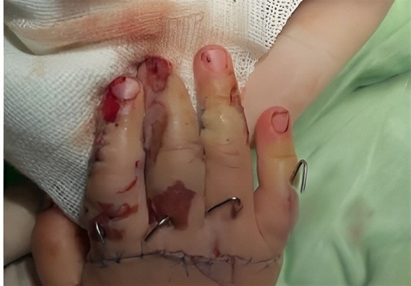 پیوند انگشتان دختربچه یکساله با جراحی 7 ساعته در خرمآباد / اخبار لرستان - اخبار استانها