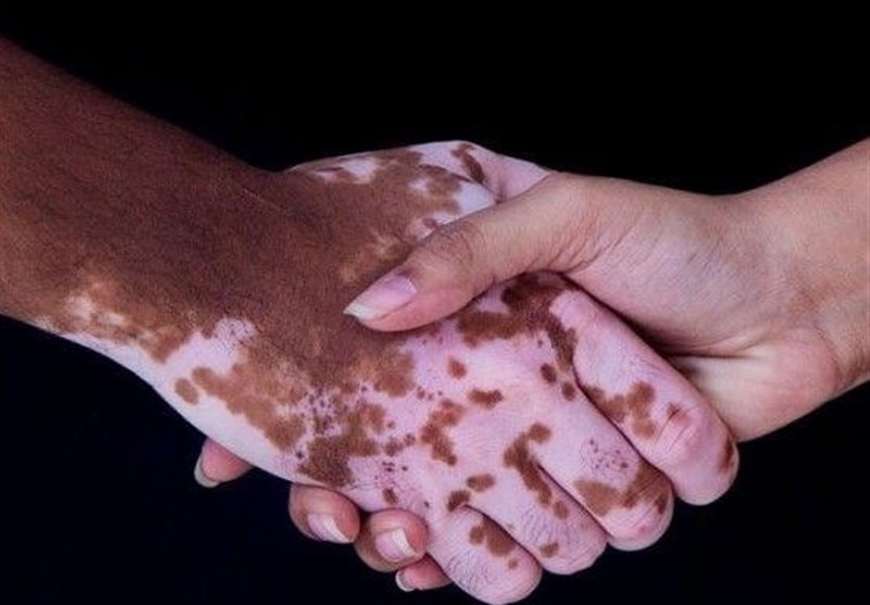 آغاز درمان یک بیماری مادرزادی با سلولهای بنیادی در شیراز / اخبار فارس - اخبار استانها